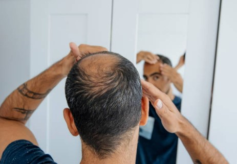 8 Causes of Hair Loss In Men And How to Promote Regrowth 